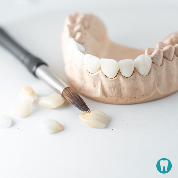 Bezmetalne krunice i mostovi