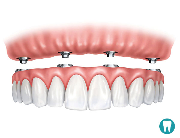 All-on-4 implanti