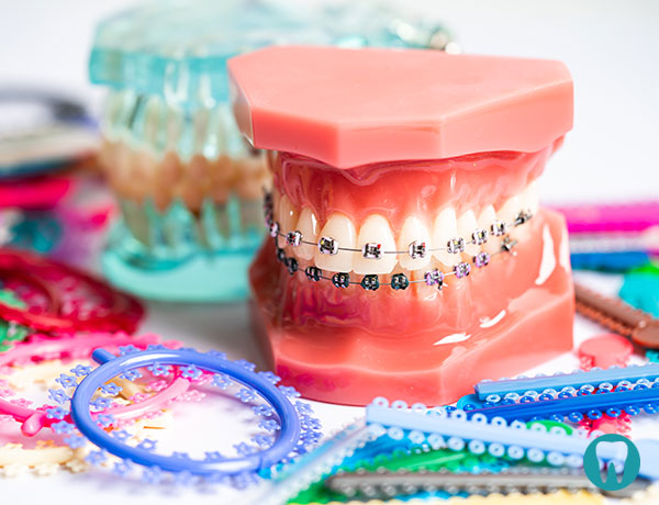 Fiksni ortodontski aparat