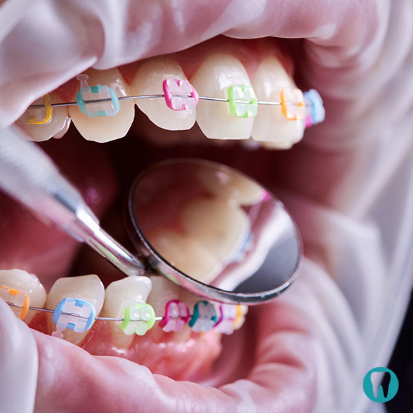 Fiksni ortodontski aparat